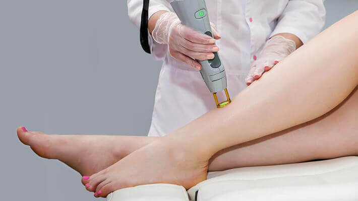 Laser hair removal