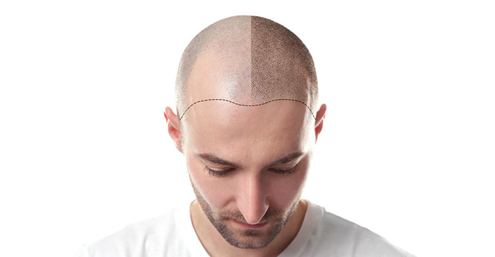 Hair transplantation